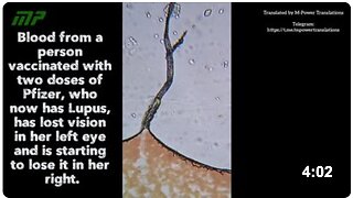 Blood from a person vaccinated with two doses of Pfizer, who now has Lupus, has lost vision in her left eye and is starting to lose it in her right.