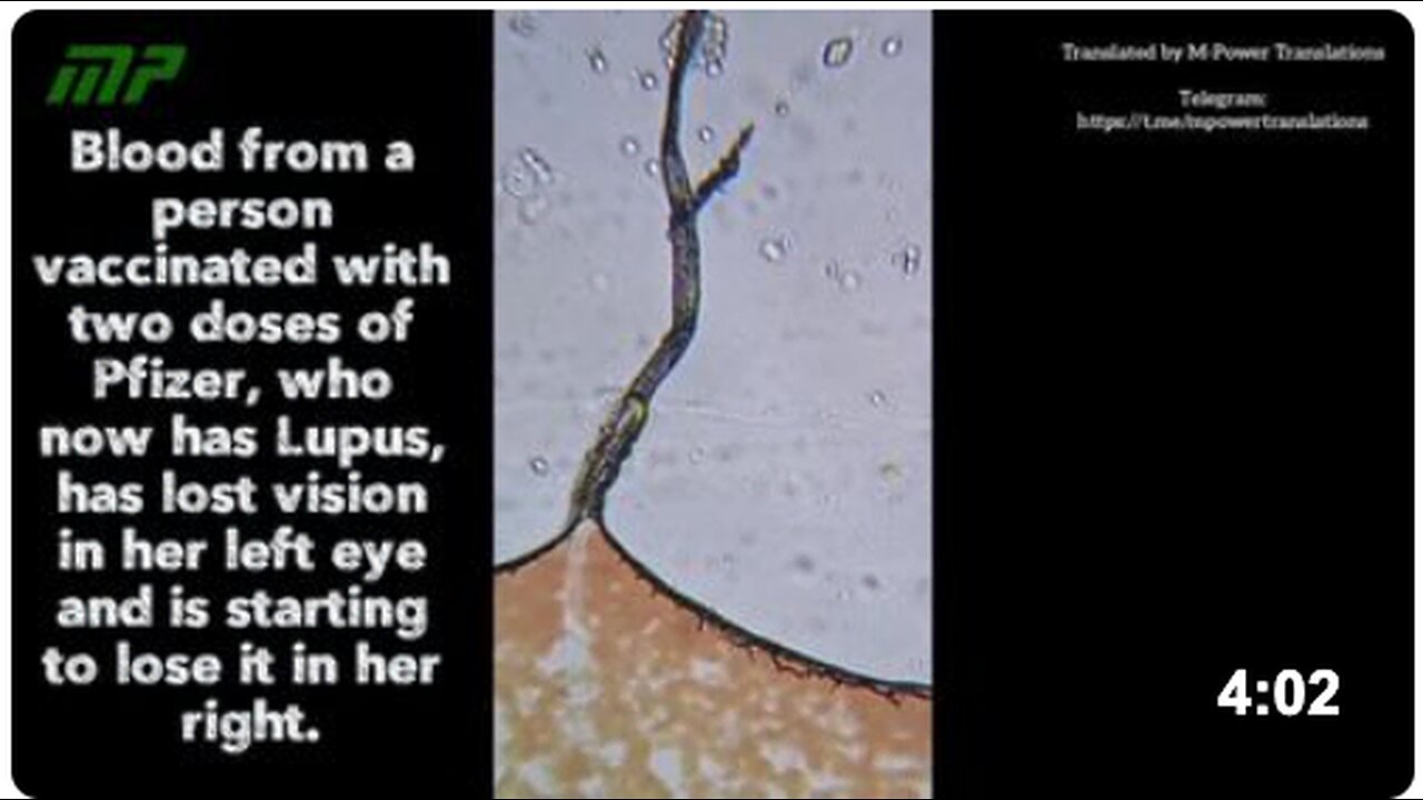Blood from a person vaccinated with two doses of Pfizer, who now has Lupus, has lost vision in her left eye and is starting to lose it in her right.