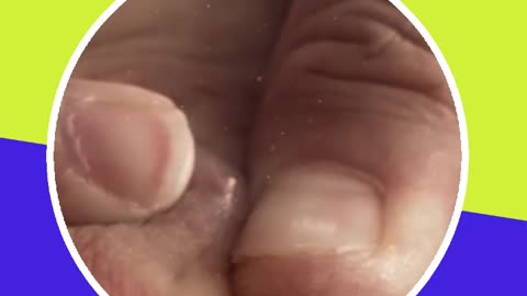 Pimple removal satisfying video (ASMR) #14 #shorts