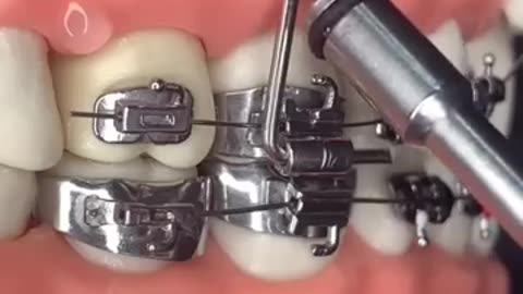Viral: Dental BRACES, ORTHODONTICS