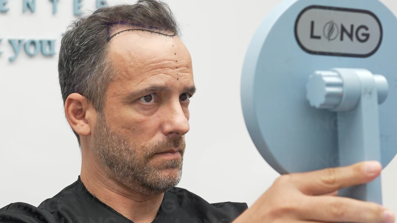 The creation of a new hairline in a natural way requires the highest level of skill and experience.