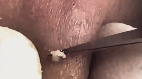 New satisfying blackhead removal #3