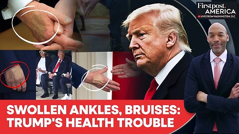 Trump Diagnosed with Chronic Venous Insufficiency That Causes Swollen Legs | Firstpost America