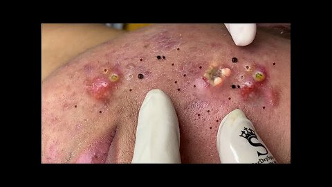 Blackheads Removal & Pimple Popper Cystic Acne Extraction 9