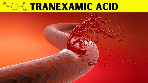 Transform Bleeding Management with Tranexamic Acid: Fast and Reliable Relief! MD74