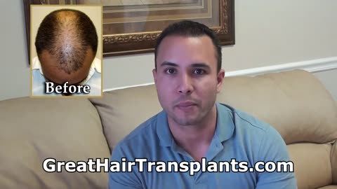 Dr. Brett Bolton – Holy Smokes! Check Out This Incredible Hair Transplant Result!
