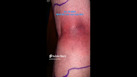 What does a Lyme rash look like?