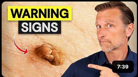 How to Remove Skin Tags and Warts Overnight