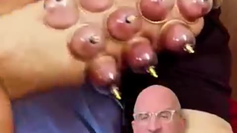 Incredible: Cupping Therapy - Pain Relief or Nonsense⁉️ #shorts