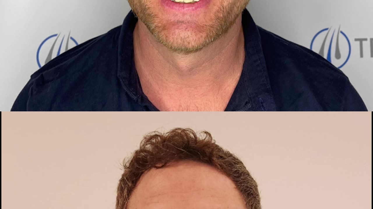 INSANE Hair Transplant Results! ⚡