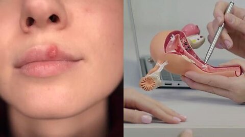 Discovery That Completely Changed The Way We Understand and Treat Herpes