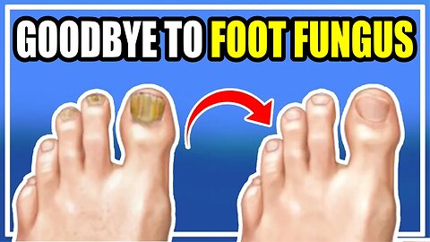 SAY GOODBYE to FOOT FUNGUS! TRY THIS, YOU WON'T REGRET IT!
