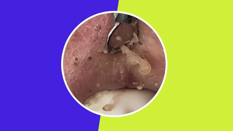 Skincare | Blackheads Removal #2 #tweezers #skincare #blackheads