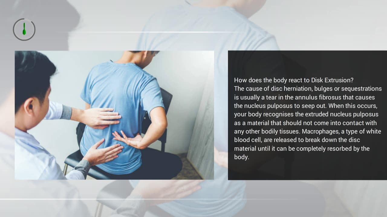 Tired Of Living With Back Pain Due To Disk Extrusion Try Disk Extrusion Treatment