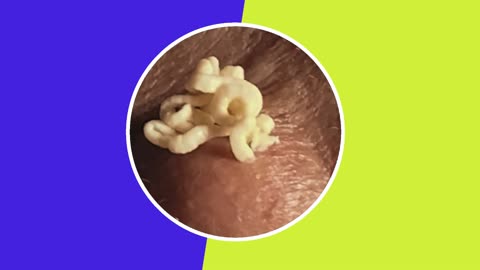 Pimple removal satisfying video (ASMR) #1