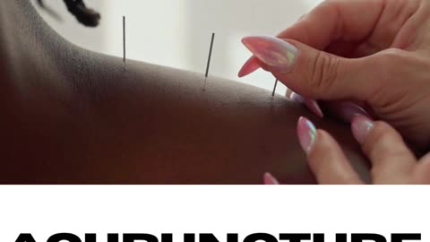Acupuncture Treatment in Toronto – Natural Pain Relief & Stress Relief