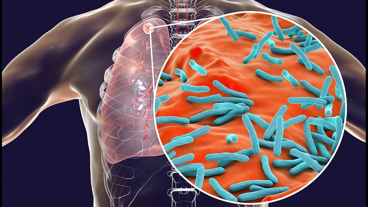 Grandes tueuses : La tuberculose | Inserm [Flokossama]