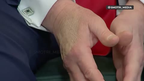 Signs of chronic venous insufficiency on Trump’s hand reportedly covered with makeup