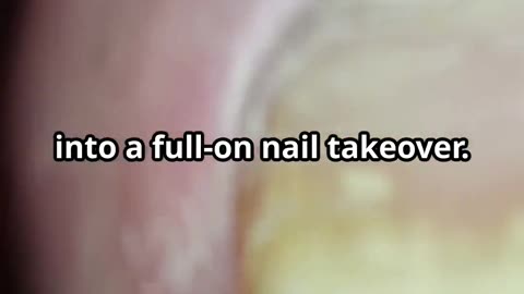 How Nail Fungus Spreads (And What Happens If You Don’t Treat It)