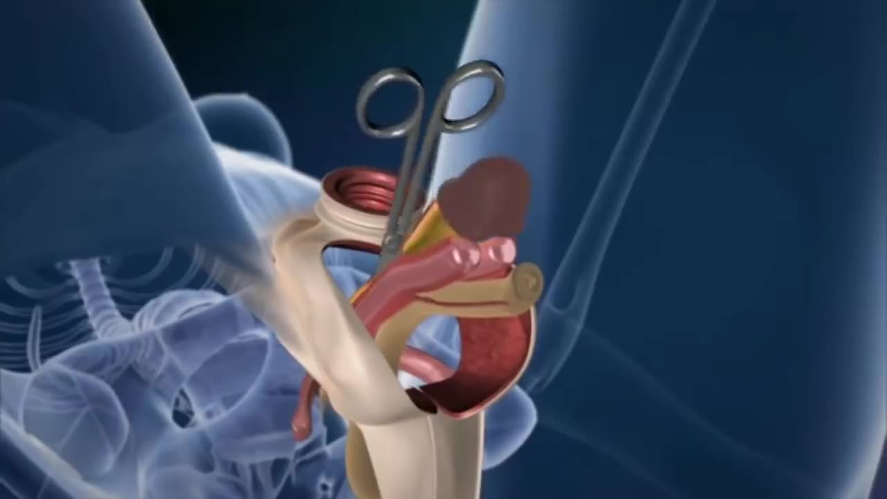 Male to Female transformation procedure