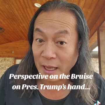 HAND BRUISES ✋️ SHAKING SO MANY HANDS