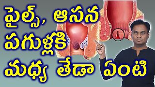 పైల్స్, ఆసన పగుళ్లకి తేడా | Piles Vs Anal Fissure Difference | Hemorrhoids Best Homeopathy Treatment
