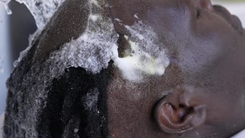 Afro hair transplant needs more care and attention than other procedures