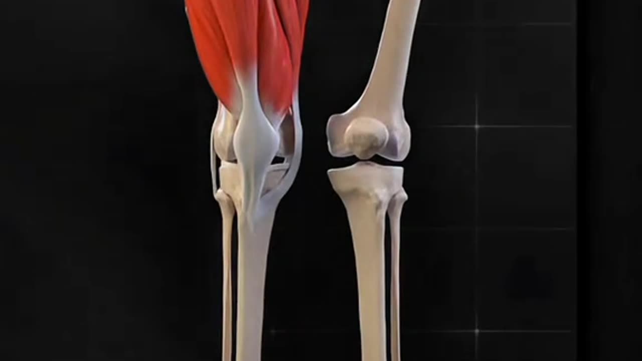 Femur Osteotomy Explained! How Surgeons Correct Bone Alignment