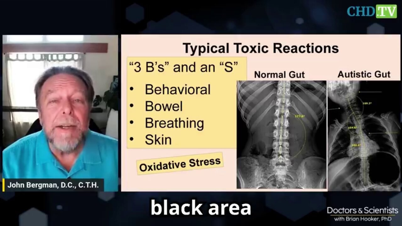 Autism and The Gut-Brain Connection Which Raw Milk Cures by CHD.TV