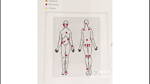 IMPLANTS • TARGETED INDIVIDUALS