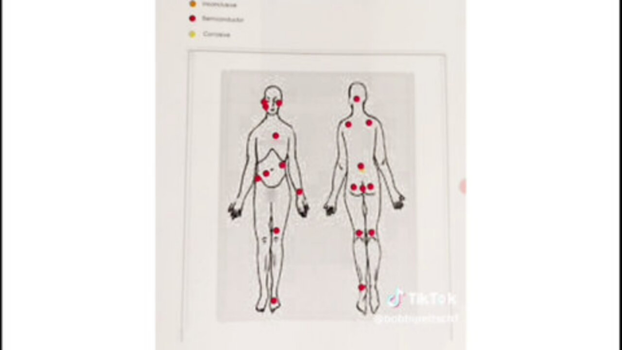 IMPLANTS • TARGETED INDIVIDUALS