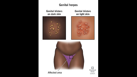 HERPES CONNECTION TO CANCER, BLACK AMERICAN WOMEN HAVE THE HIGHEST RATES OF HERPES INFECTION AT 48 PERCENT: ONE IN TWO BETWEEN THE AGES OF 14 & 49 IS INFECTED WITH HSV-2.🕎Nehemiah 9:26-37 “cast thy law behind their back”