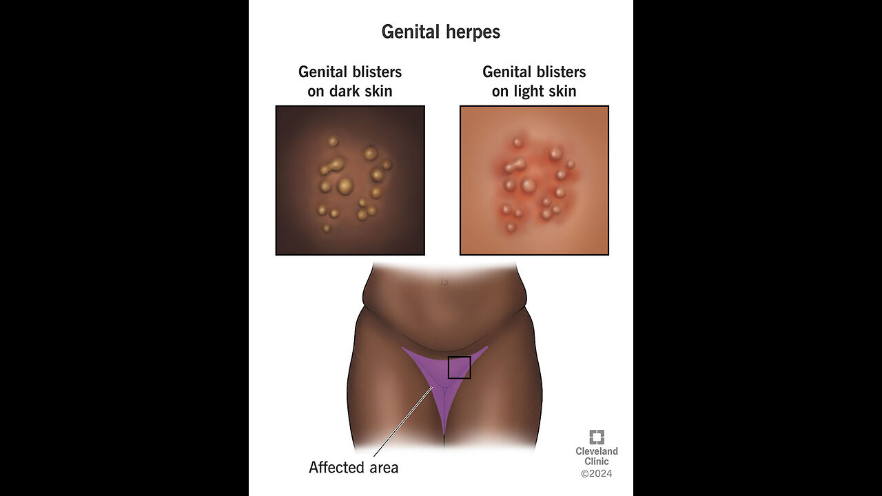 HERPES CONNECTION TO CANCER, BLACK AMERICAN WOMEN HAVE THE HIGHEST RATES OF HERPES INFECTION AT 48 PERCENT: ONE IN TWO BETWEEN THE AGES OF 14 & 49 IS INFECTED WITH HSV-2.🕎Nehemiah 9:26-37 “cast thy law behind their back”
