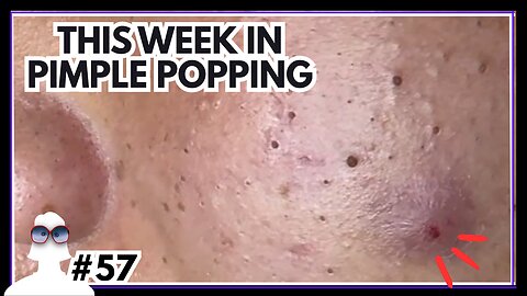 This Week In PIMPLE POPPING #57