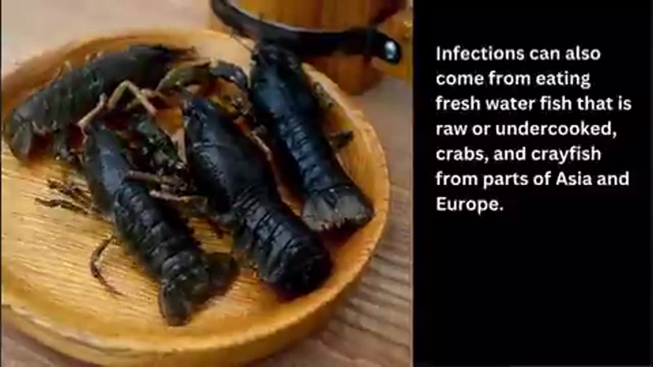 People in the U.S. get infected with liver flukes P2