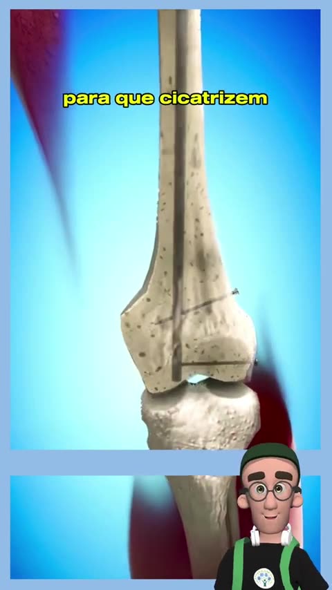 _medicina _fratura _saude _biologia _ciencia _vocesabia _curiosidades(