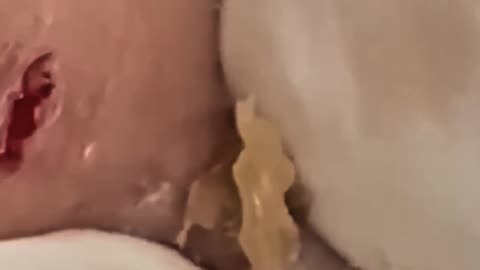 Satisfying Blackhead and Pimple Removal #1 #shorts
