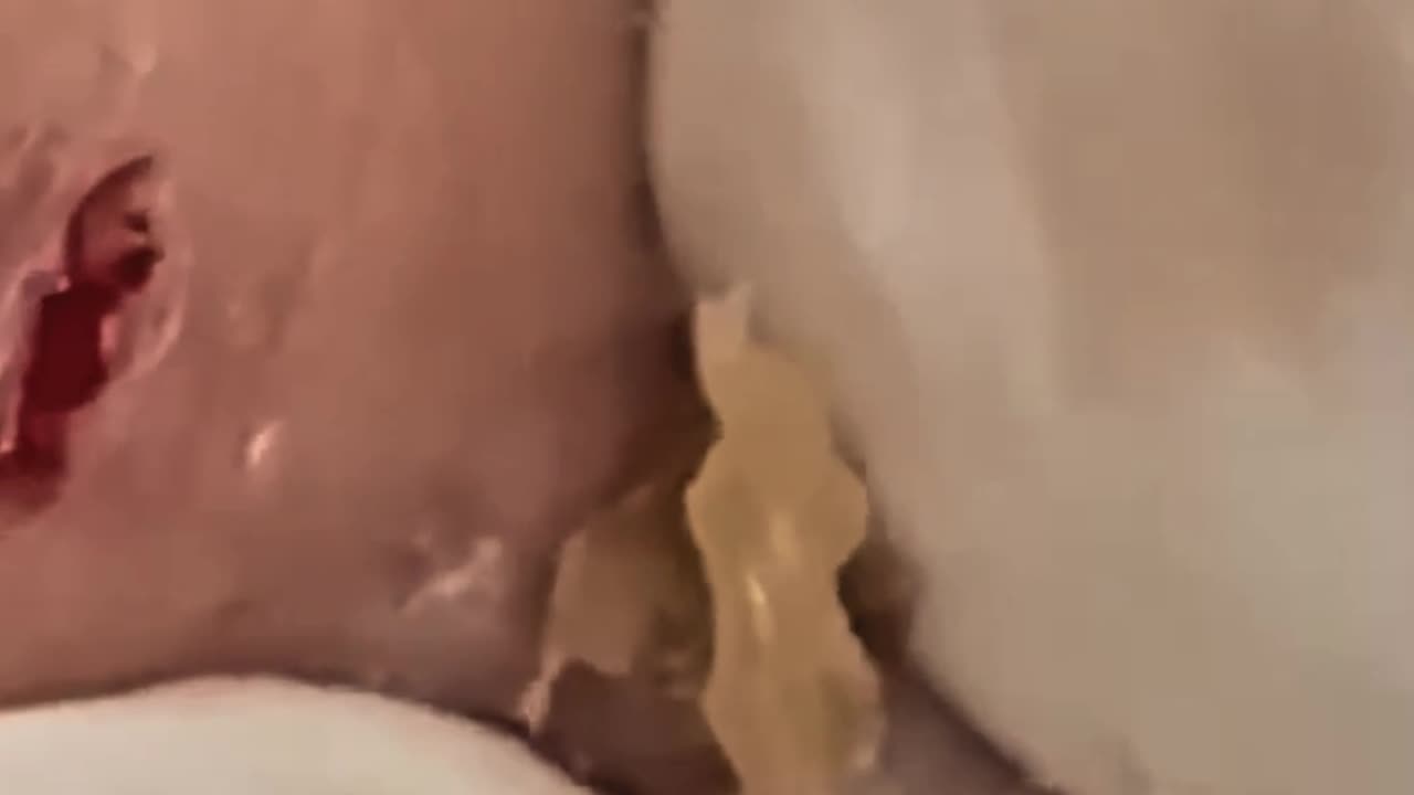 Satisfying Blackhead and Pimple Removal #1 #shorts