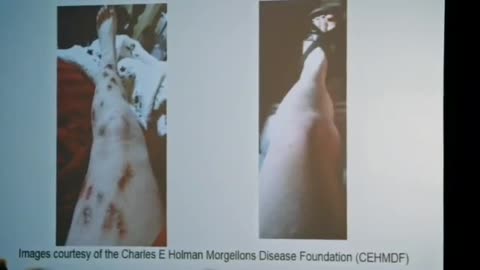 Documentary - Skin Deep: The Battle. Over Morgellons (2020)