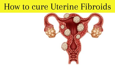 How To Cure Uterine Fibroids