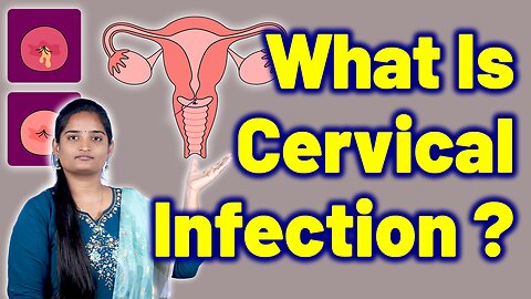 What Is Cervicitis In Women | Cervical Swelling, Infected Cervix, Acute Cervicitis | Gynaecology