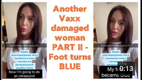 "Part II: Woman's Foot Turns Blue Due to Vaccine Damage"