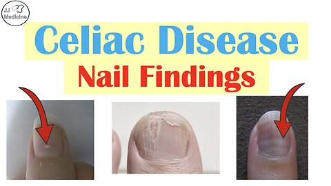 What Your Nails Say About Celiac Disease (You Didn’t Know This!)