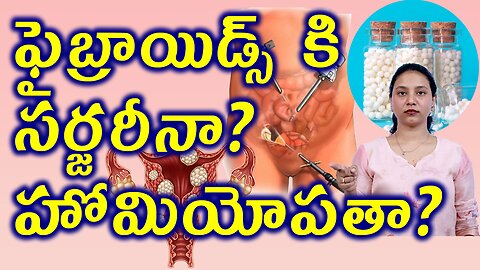 ఫైబ్రాయిడ్స్ కి సర్జరీనా?హోమియోపతినా? Best Fibroids Homepathy Treatment Myomectomy Surgery Medicine
