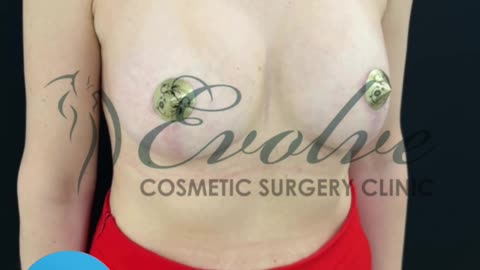Breast Lift & Volume Enhancement | Before & After 300ml Implant Journey