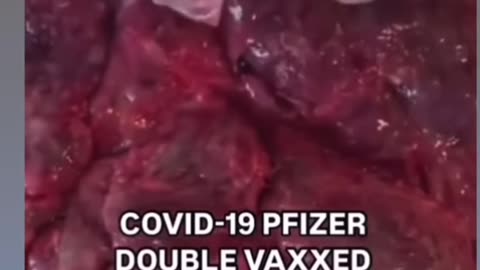 Vac cin ated placenta. Don't get the jab. None still don't