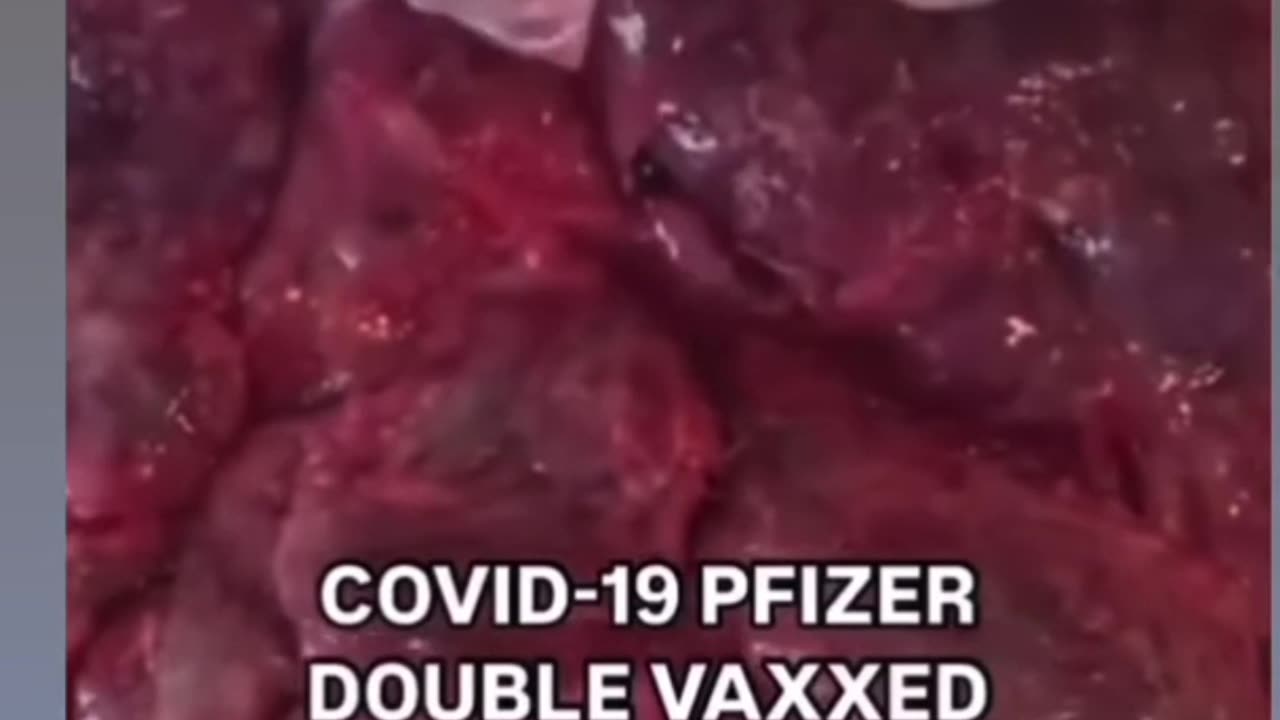 Vac cin ated placenta. Don't get the jab. None still don't