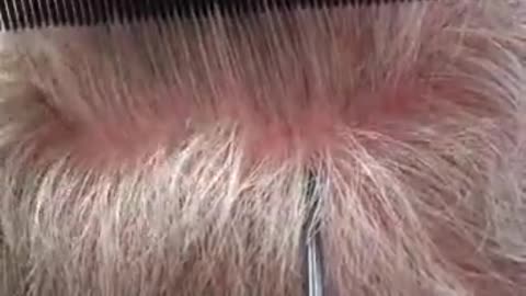 Dr. Brett Bolton Shows Another Amazing Undetectable Suture Line