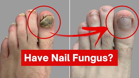 How To Get Rid of Your Nail Fungus