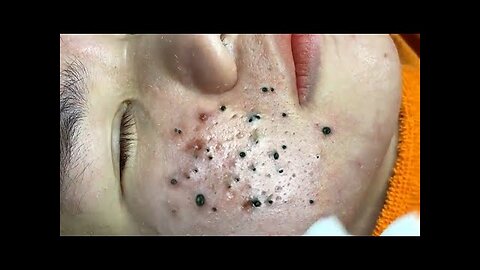 blackhead removal and Pimplepopping Spa relaxation